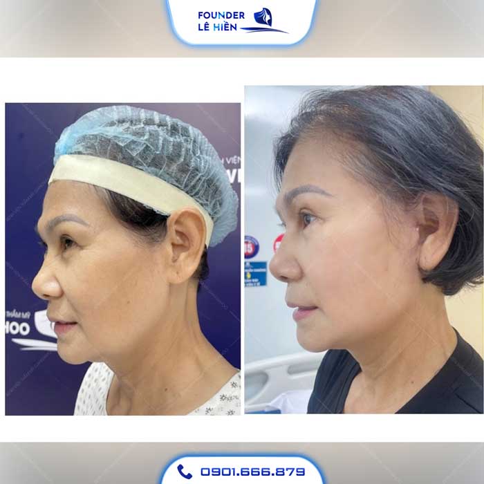 Khách hàng thực hiện Căng Da Mặt Bằng Chỉ Nâng Cơ Lifting Collagen