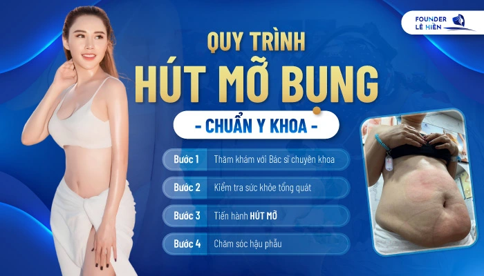 Quy trình hút mỡ bụng chuẩn Y khoa