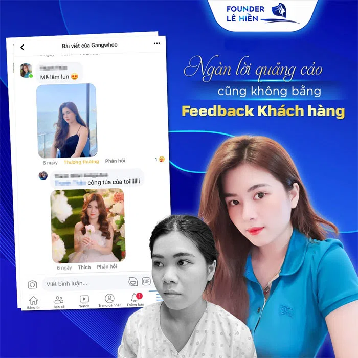 feedback của khách hàng nâng mũi