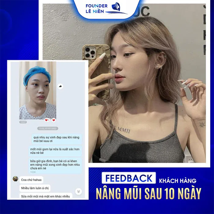 feedback của khách hàng nâng mũi