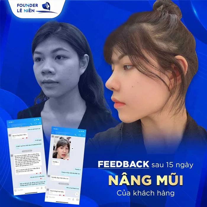 feedback của khách hàng nâng mũi