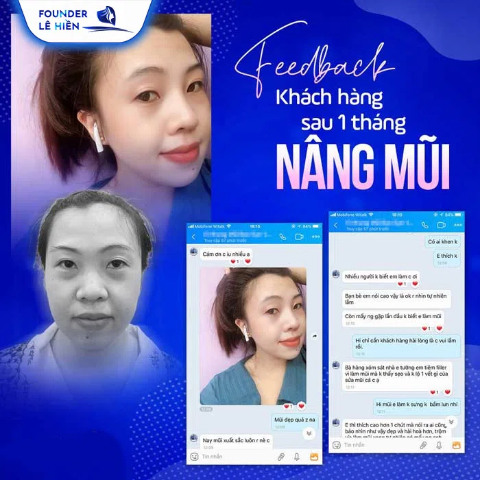 feedback của khách hàng nâng mũi