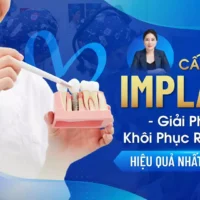 Cay-Ghep-Implant-–-Giai-Phap-Khoi-Phuc-Rang-Mat-Hieu-Qua-Nhat-Hien-Nay.webp