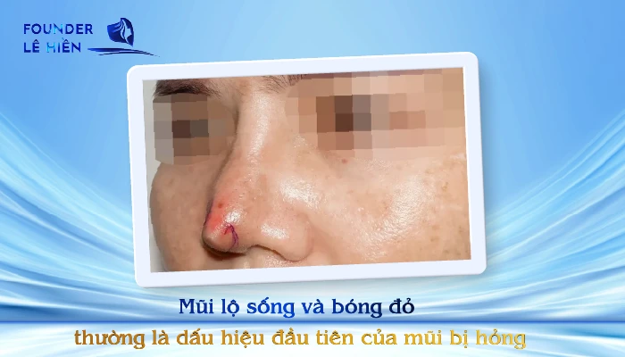 Mui lo song va bong do thuong la dau hieu dau tien cua mui bi hong 01