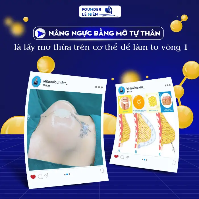 Nâng ngực bằng mỡ tự thân