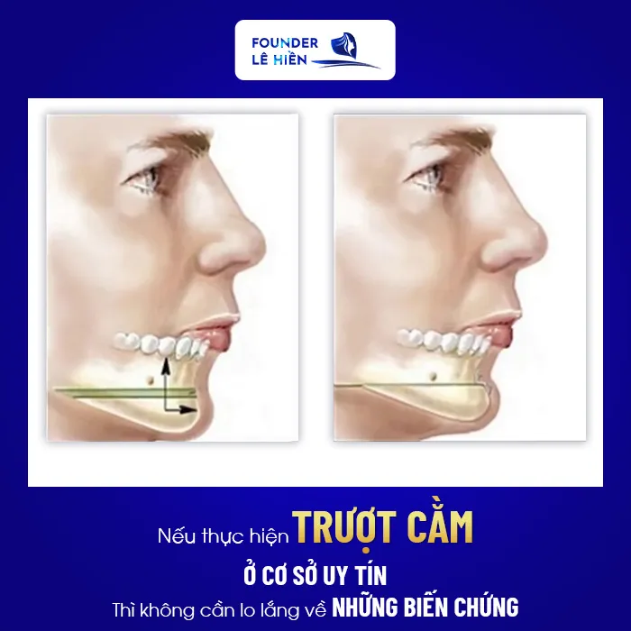 Trượt cằm