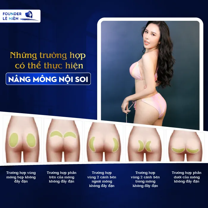 Nâng Mông Nội Soi