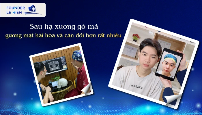 Hạ gò má