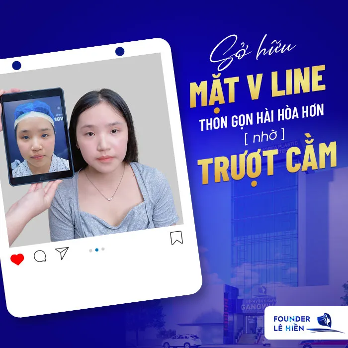 Trượt cằm