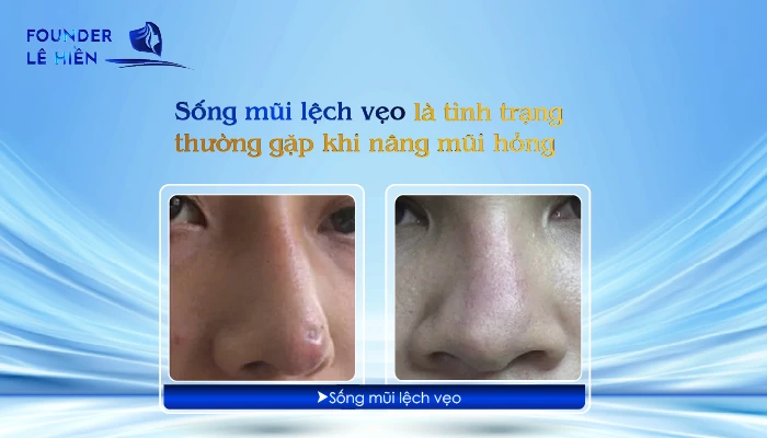 Sửa Mũi Hỏng 