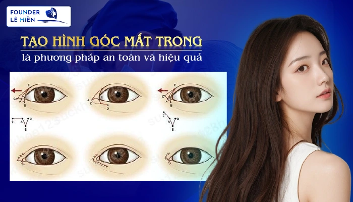 Tạo Hình Góc Mắt Trong