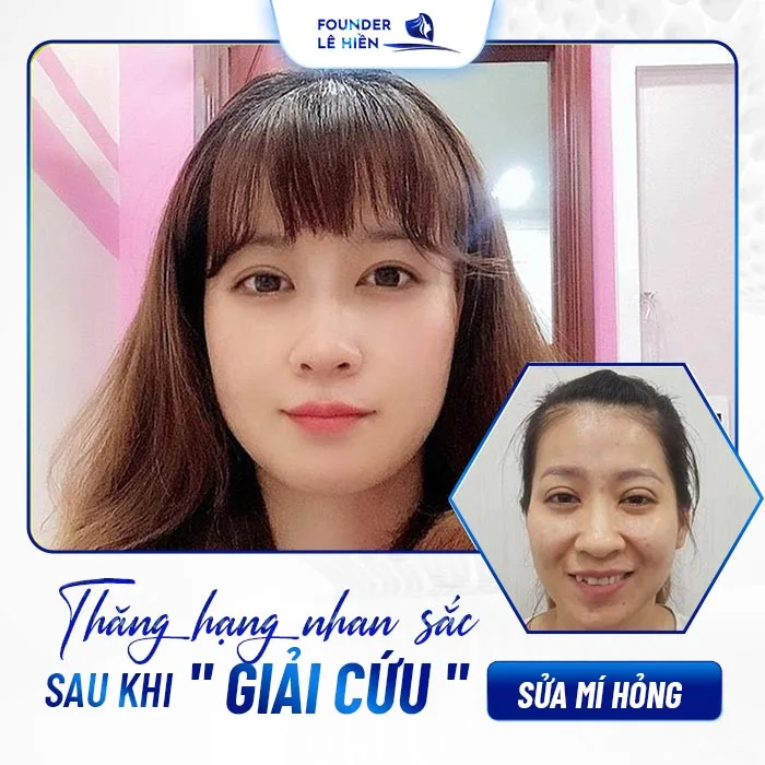 Sửa mí hỏng