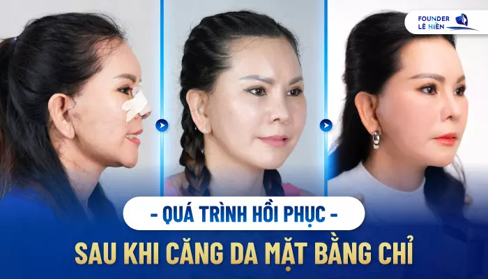 Vùng da mới căng chỉ sẽ bị sưng nhẹ trong khoảng 3-5 ngày, và sẽ hồi phục hoàn toàn sau 1-2 tuần. 