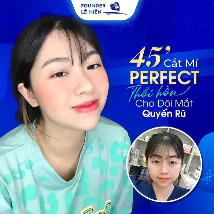 Khách hàng cắt mí mắt Perfect tại Bệnh viện Gangwhoo