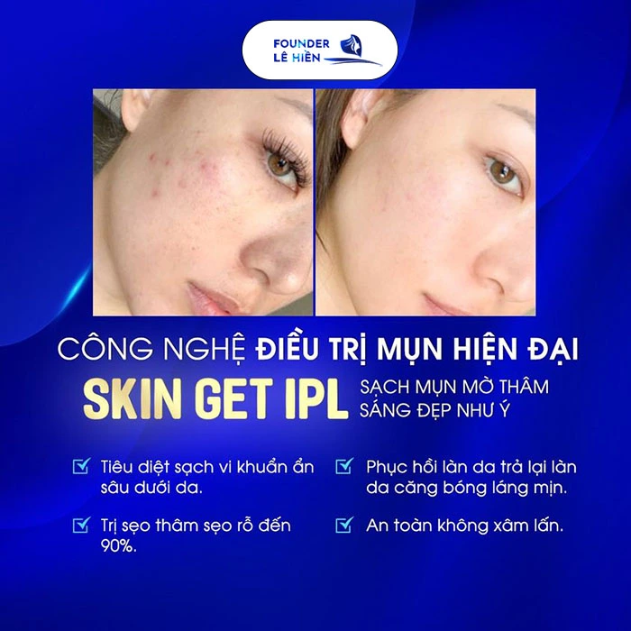 Điều trị mụn Skin Get IPL - công nghệ điều trị mụn đến từ Hàn Quốc