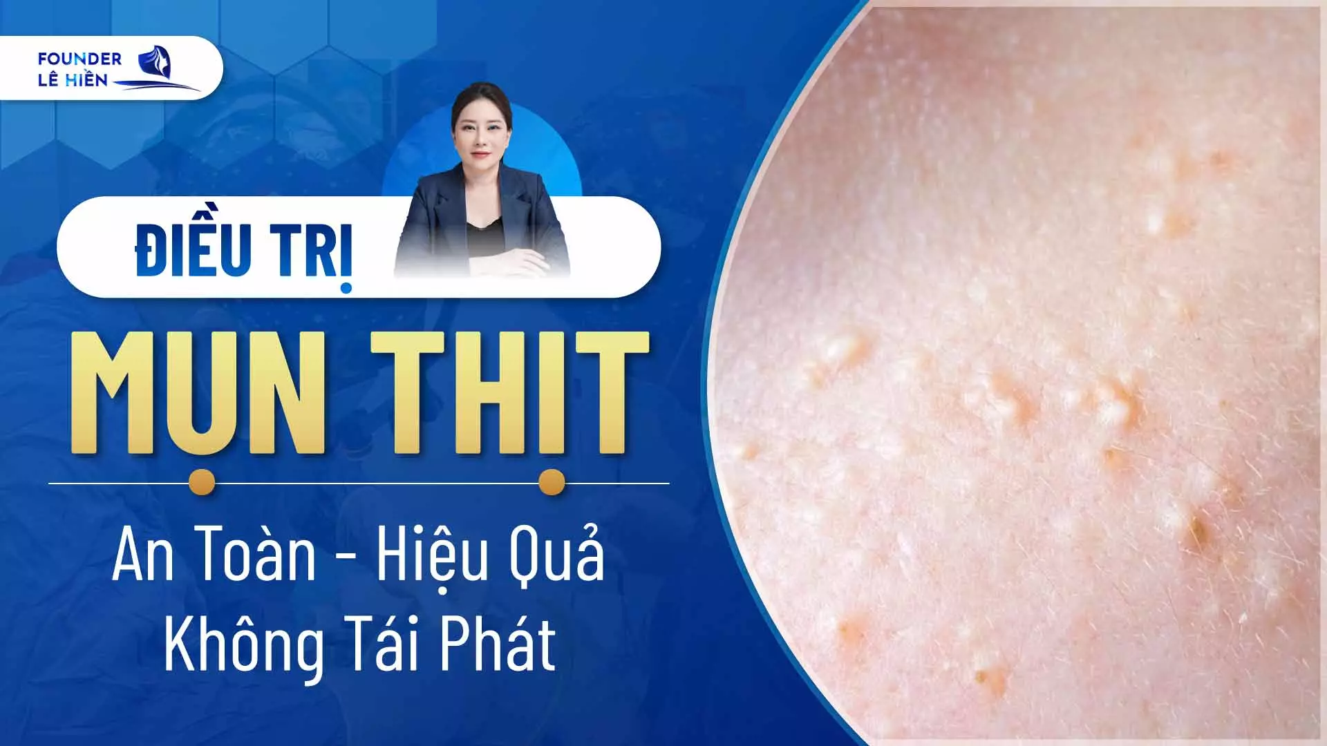 Điều Trị Mụn Thịt: An Toàn - Hiệu Quả - Không Tái Phát