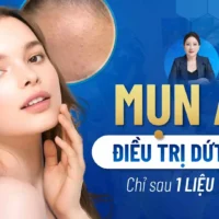 dieu-tri-mun-thit (4)