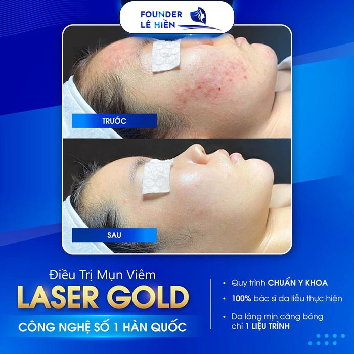 Điều trị mụn bằng Laser Gold là công nghệ thẩm mỹ thế hệ mới dùng bước sóng 585 nm để điều trị mụn viê