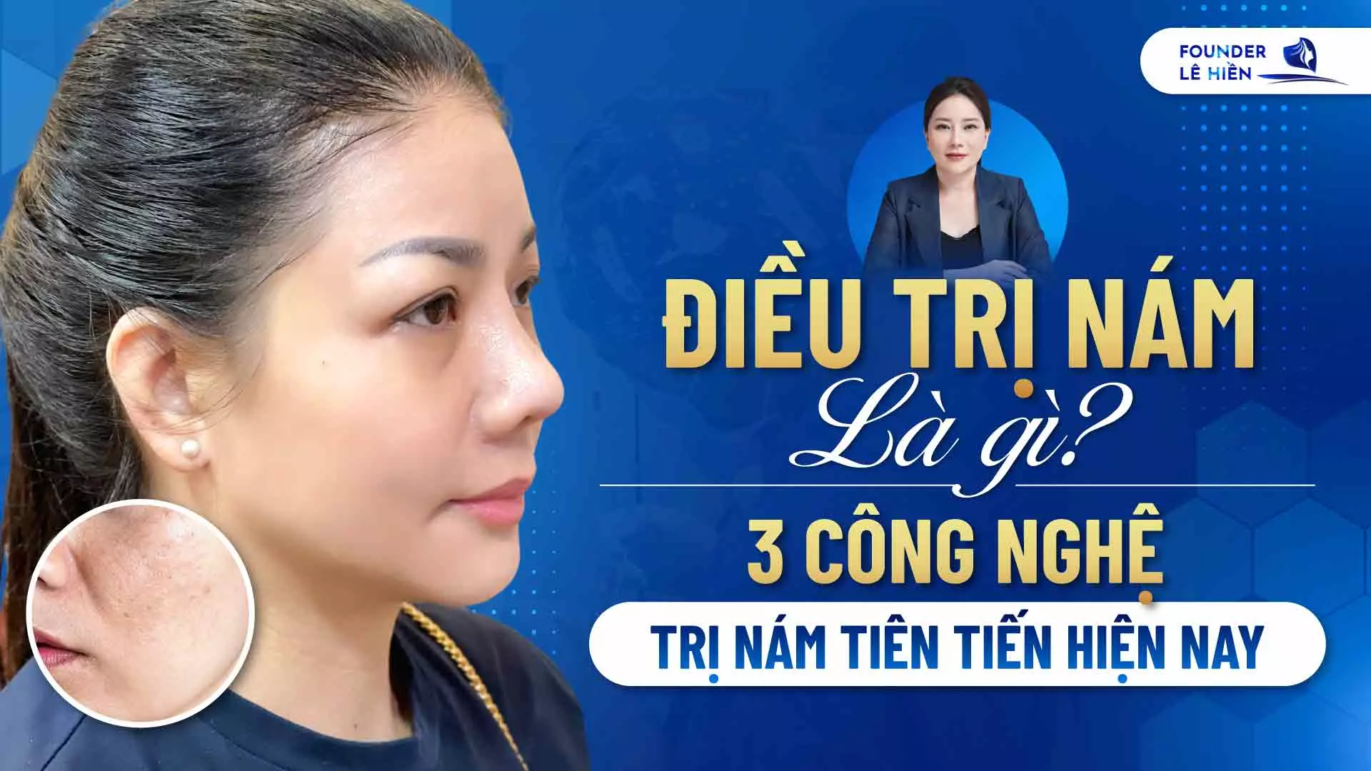 Điều Trị Nám Là Gì? 3 Công Nghệ Trị Nám Tiên Tiến Hiện Nay