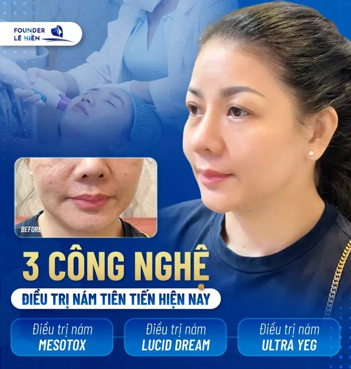 Điểm nhanh 3 công nghệ điều trị nám tiên tiến hiện nay