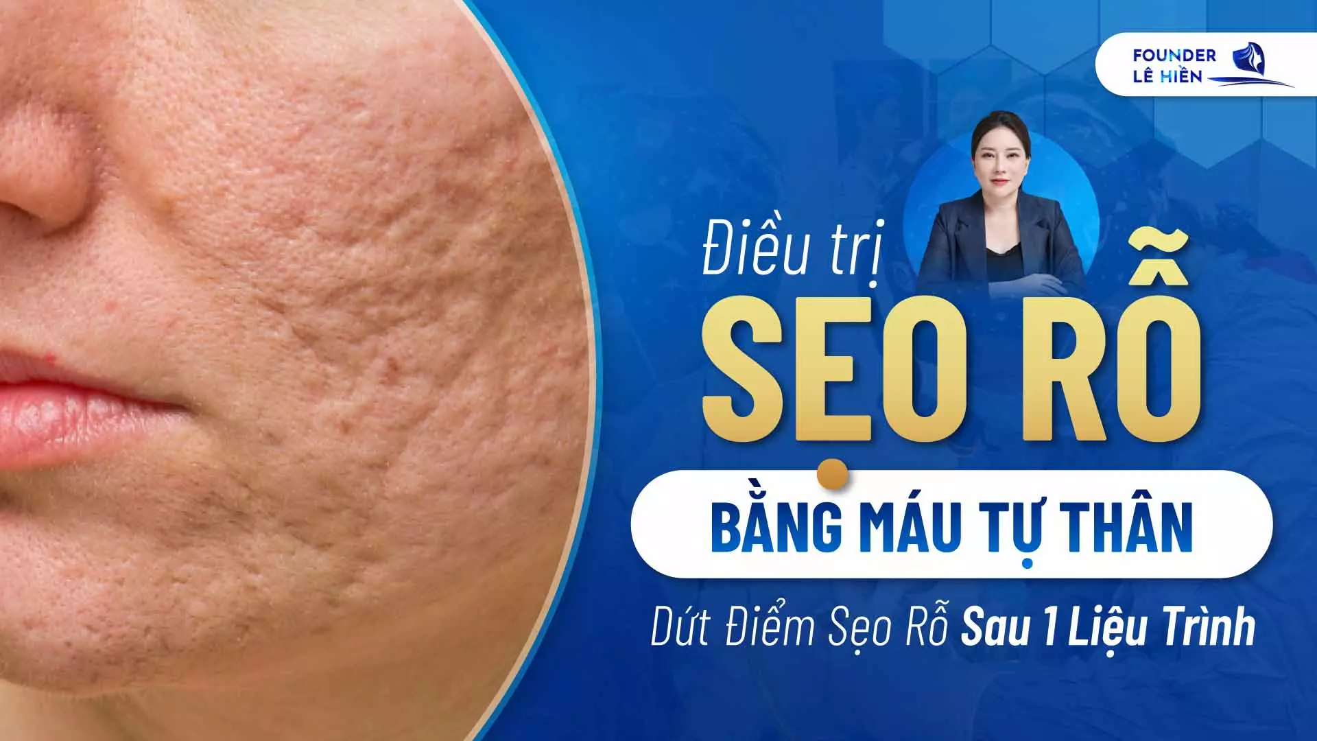 dieu tri seo ro bang mau tu than 1 1