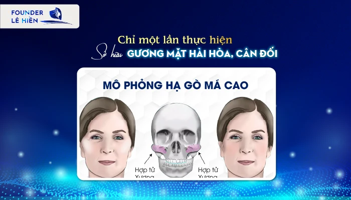 Hạ gò má