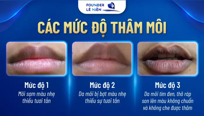 Môi thâm có nhiều cấp độ khác nhau