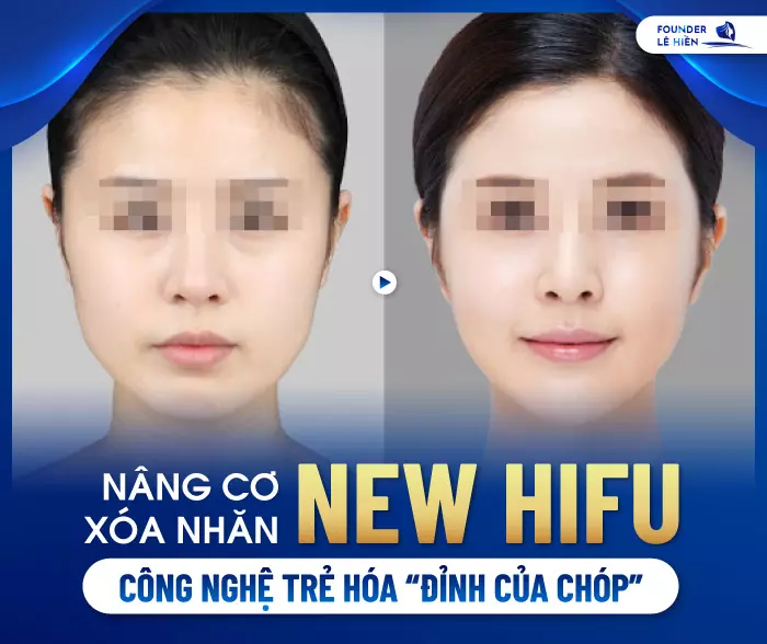 Nâng cơ xóa nhăn New Hifu là công nghệ trẻ hóa da bằng cách dùng sóng siêu âm hội tụ mạnh ở tần số 3.2 MHz