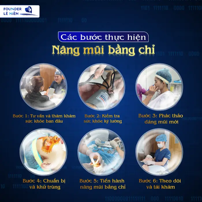 Các bước thực hiện nâng mũi bằng chỉ chuẩn an toàn và thẩm mỹ