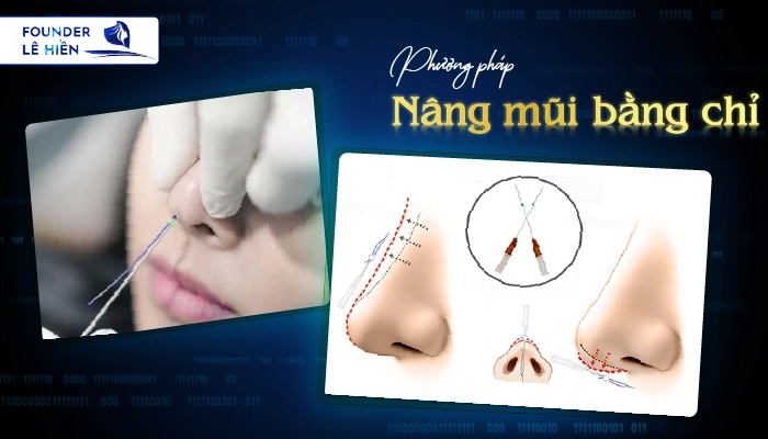 Nâng mũi bằng chỉ là gì? 