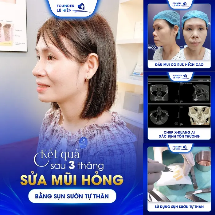 Địa chỉ nâng mũi sụn sườn uy tín và thẩm mỹ