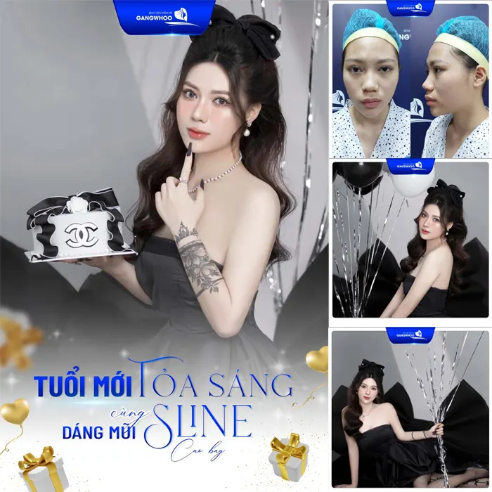 Nâng mũi cấu trúc dáng S Line