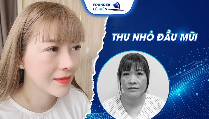 Với phương pháp thu nhỏ đầu mũi có ảnh hưởng đến sức khỏe không?