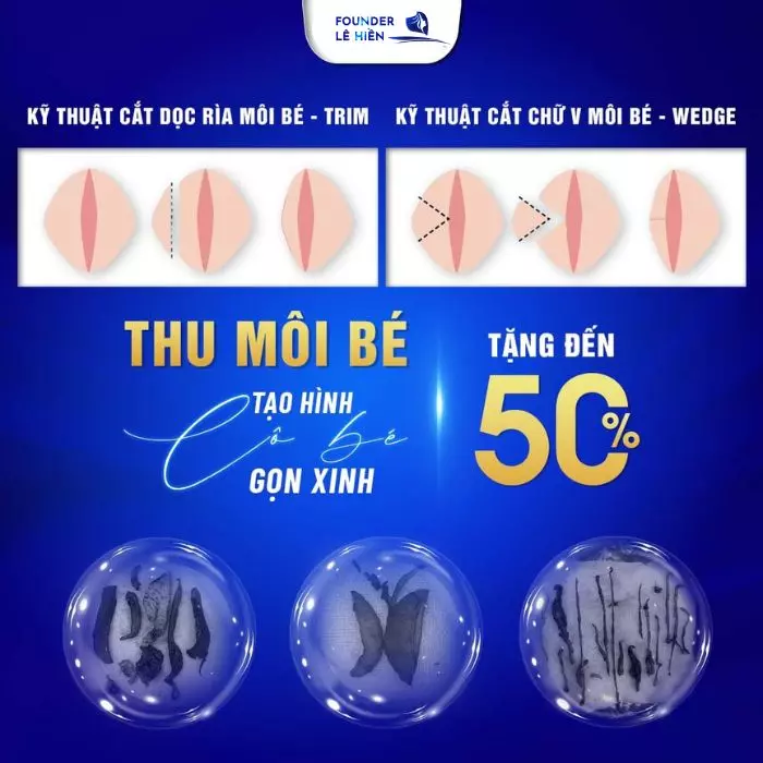 Thu nhỏ môi bé, môi lớn là tiểu phẫu đơn giản, giúp duy trì nét đẹp chúm chím cho “cô bé” thêm sức hút