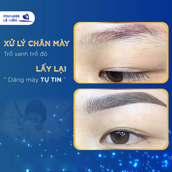 Lấy lại nét thanh tú, cân đối và giải quyết tình trạng hư hỏng, dị dạng của dáng mày. 