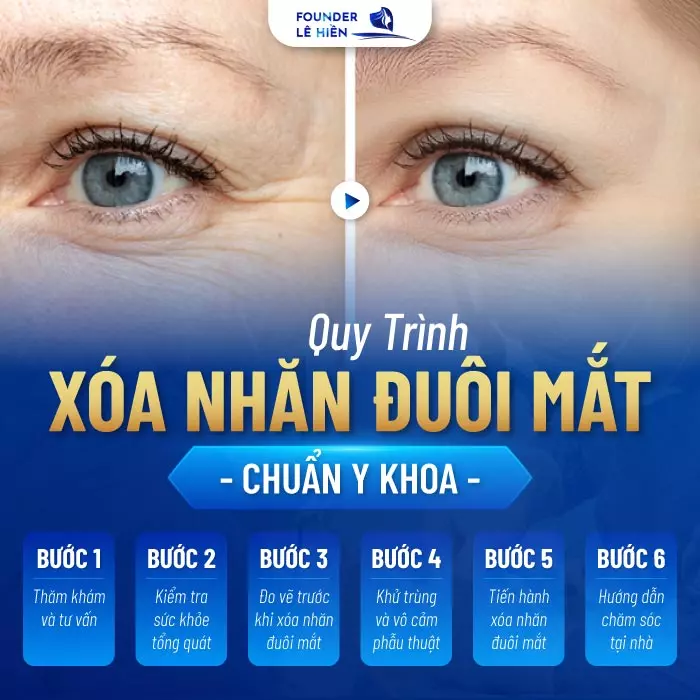 Xóa Nhăn Đuôi Mắt - Đẩy Lùi Dấu Hiệu Lão Hóa, Duy Trì Vẻ Đẹp Tươi Trẻ 5 Quy trình xóa nhăn đuôi mắt khép kín chuẩn Y khoa
