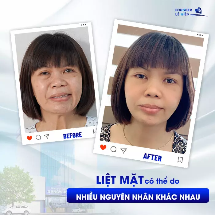 Điều trị liệt mặt