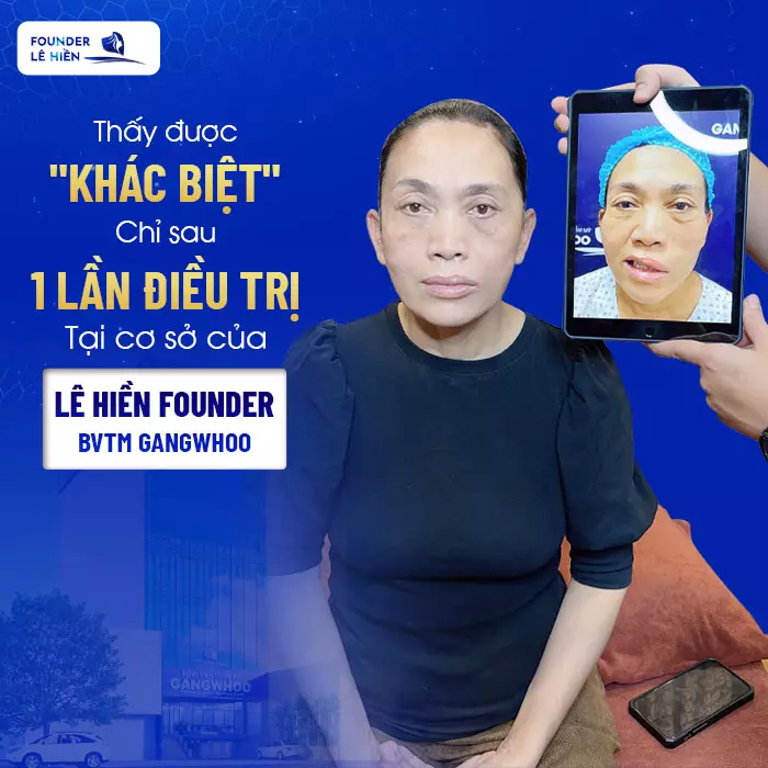 Điều trị liệt mặt