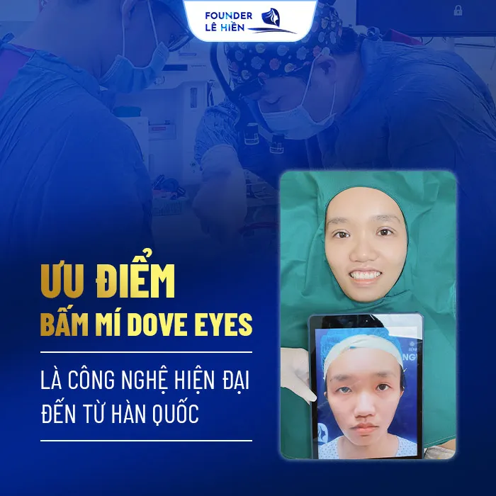 Bấm mí Dove Eyes 