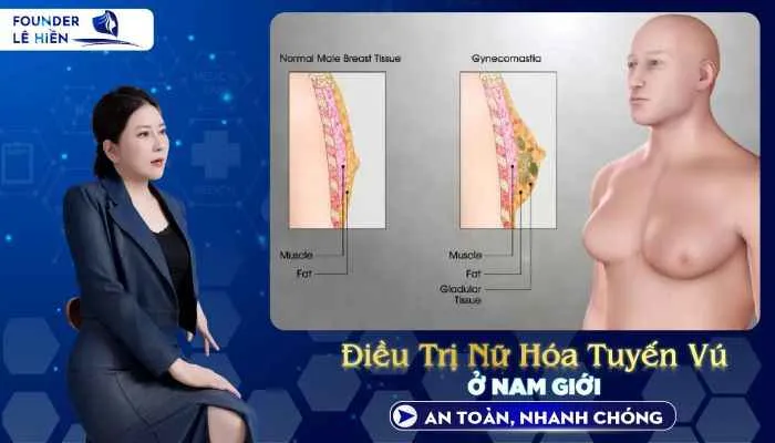 Điều Trị Nữ Hóa Tuyến Vú Ở Nam Giới An Toàn, Nhanh Chóng