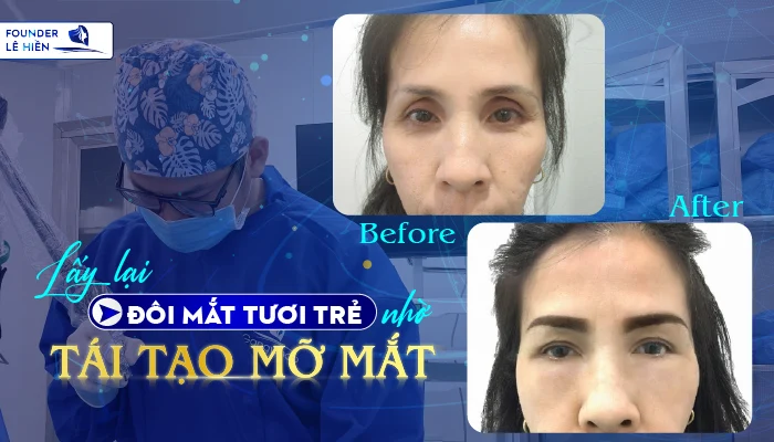 Tái tạo mỡ mắt