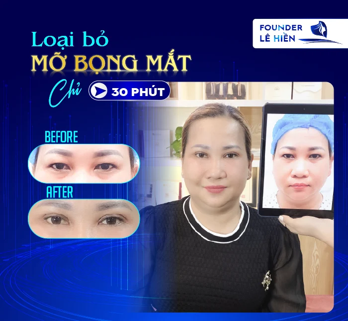 lấy mỡ mắt nội soi