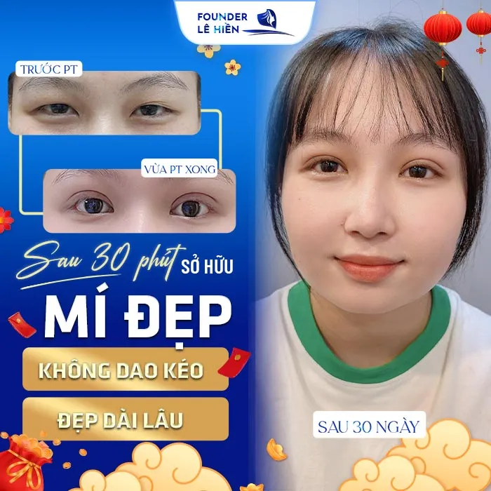 Bấm mí Dove Eyes