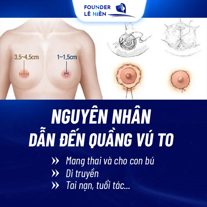 Thu nhỏ quầng vú hai bên