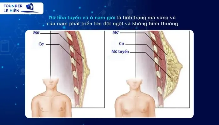 nữ hóa tuyến vú ở nam giới