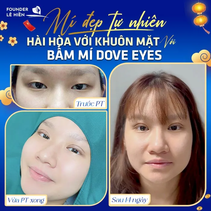 Bấm mí Dove Eyes