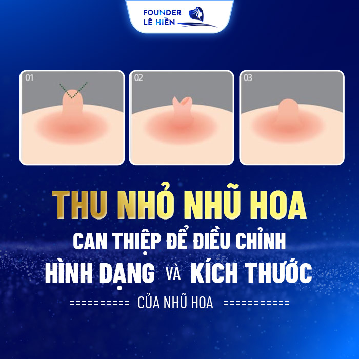 Thu nhỏ nhũ hoa