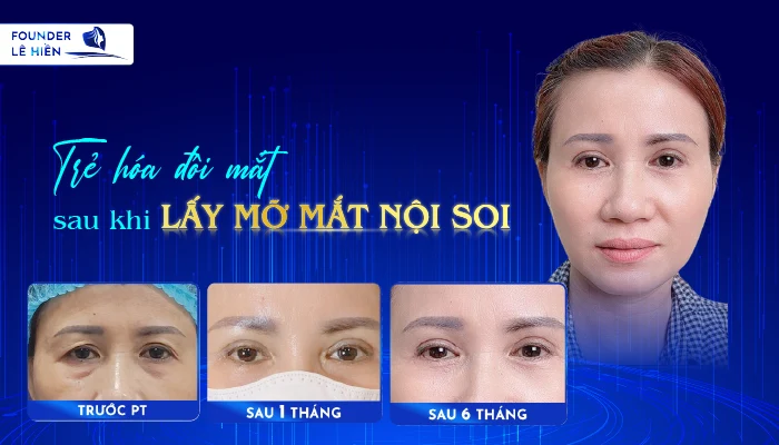 lấy mỡ mắt nội soi