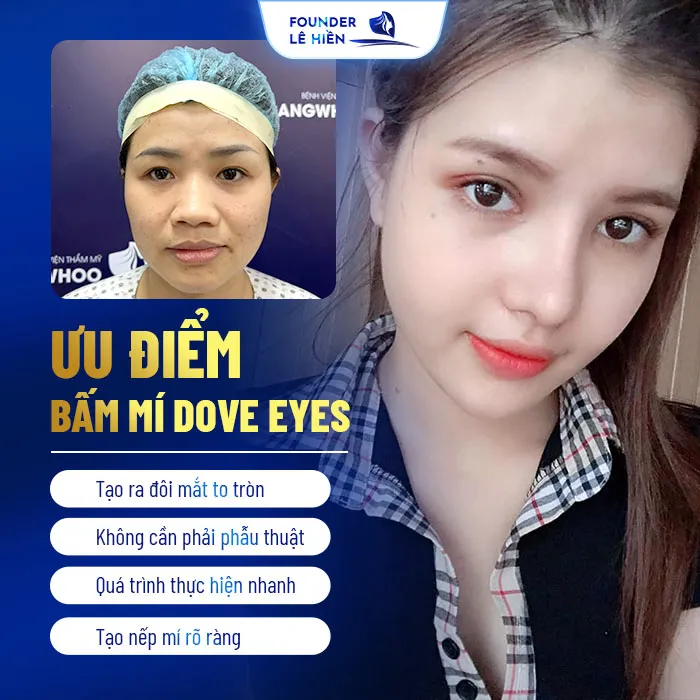 Bấm mí Dove Eyes