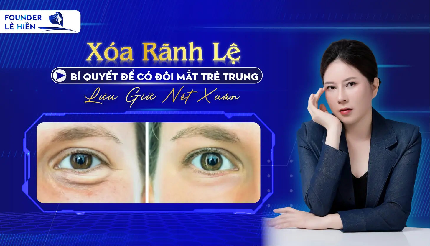 Xóa Rãnh Lệ - Bí Quyết Để Có Đôi Mắt Trẻ Trung, Lưu Giữ Nét Xuân